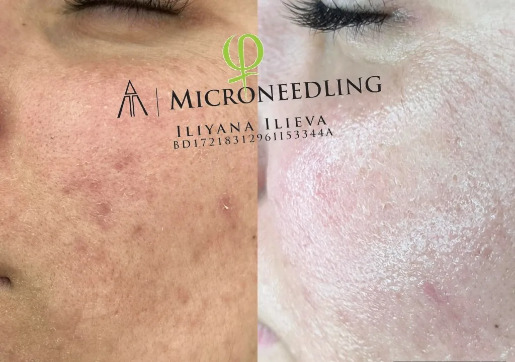 Микронидлинг – буза, акне, преди и след