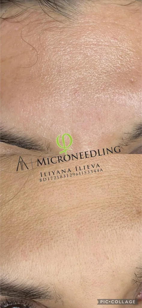 Микронидлинг – чело, пори, преди и след