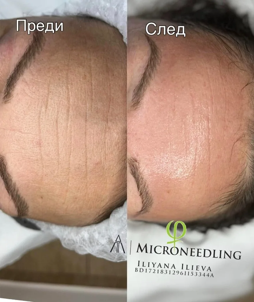 Микронидлинг – чело, фини линии, преди и след