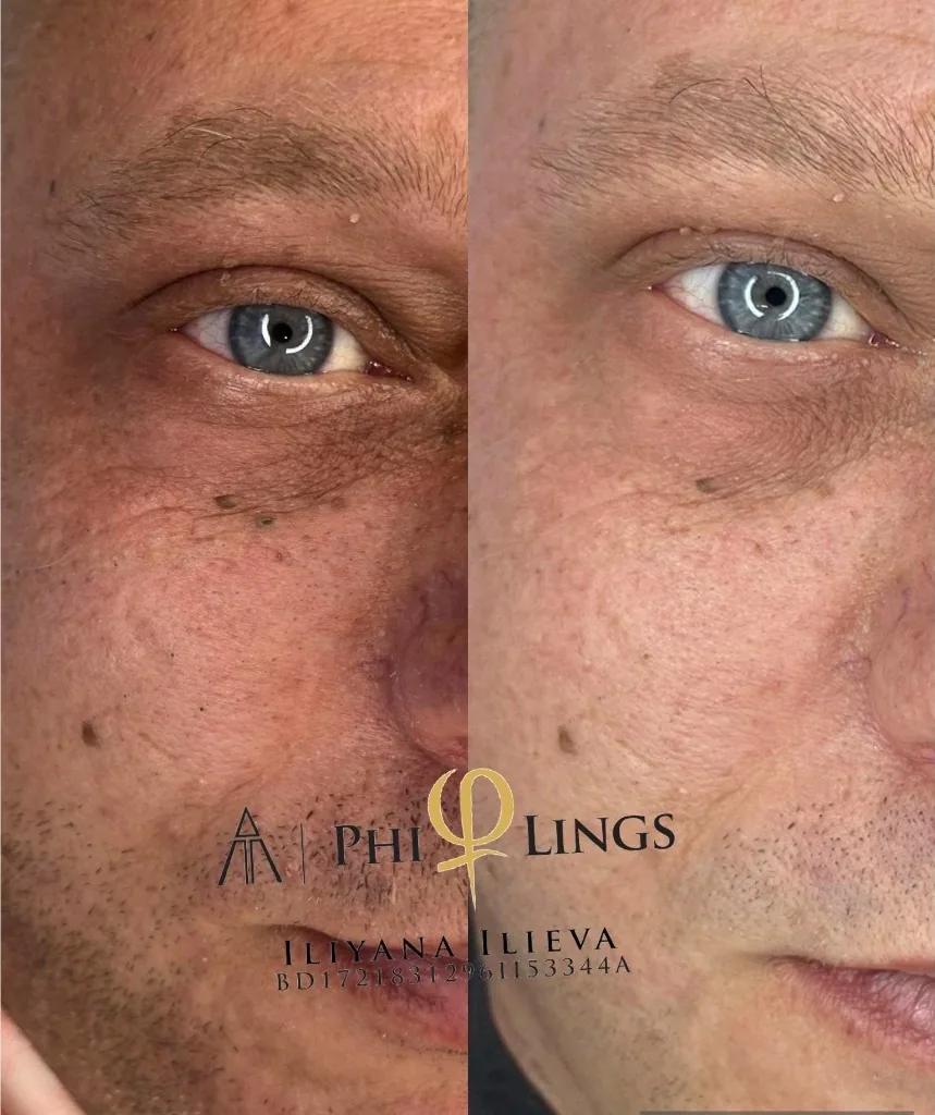 Микронидлинг – чело преди и след