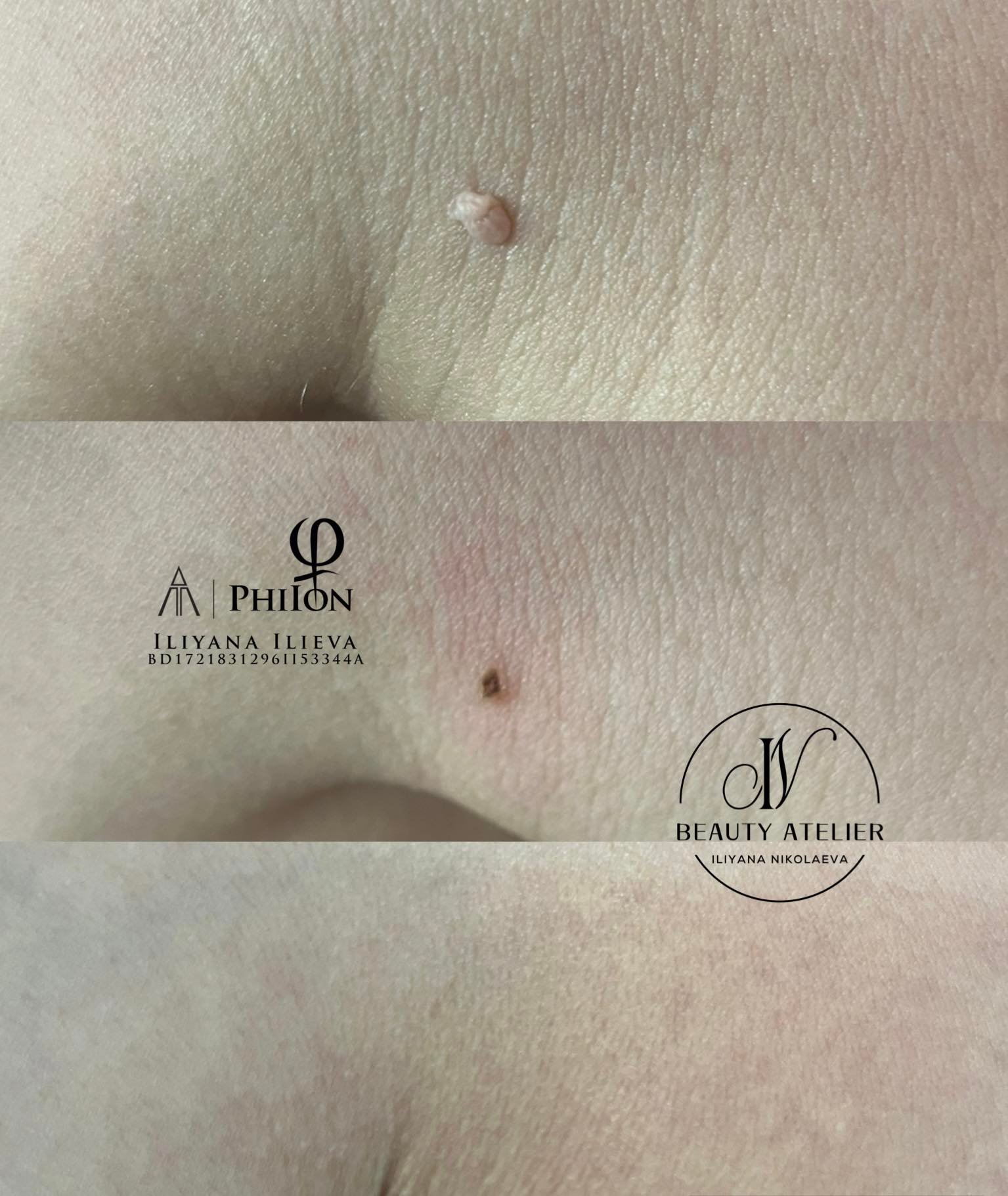 Премахване на фибром - преди и след процедурата с PhiIon в Beauty Atelier IN