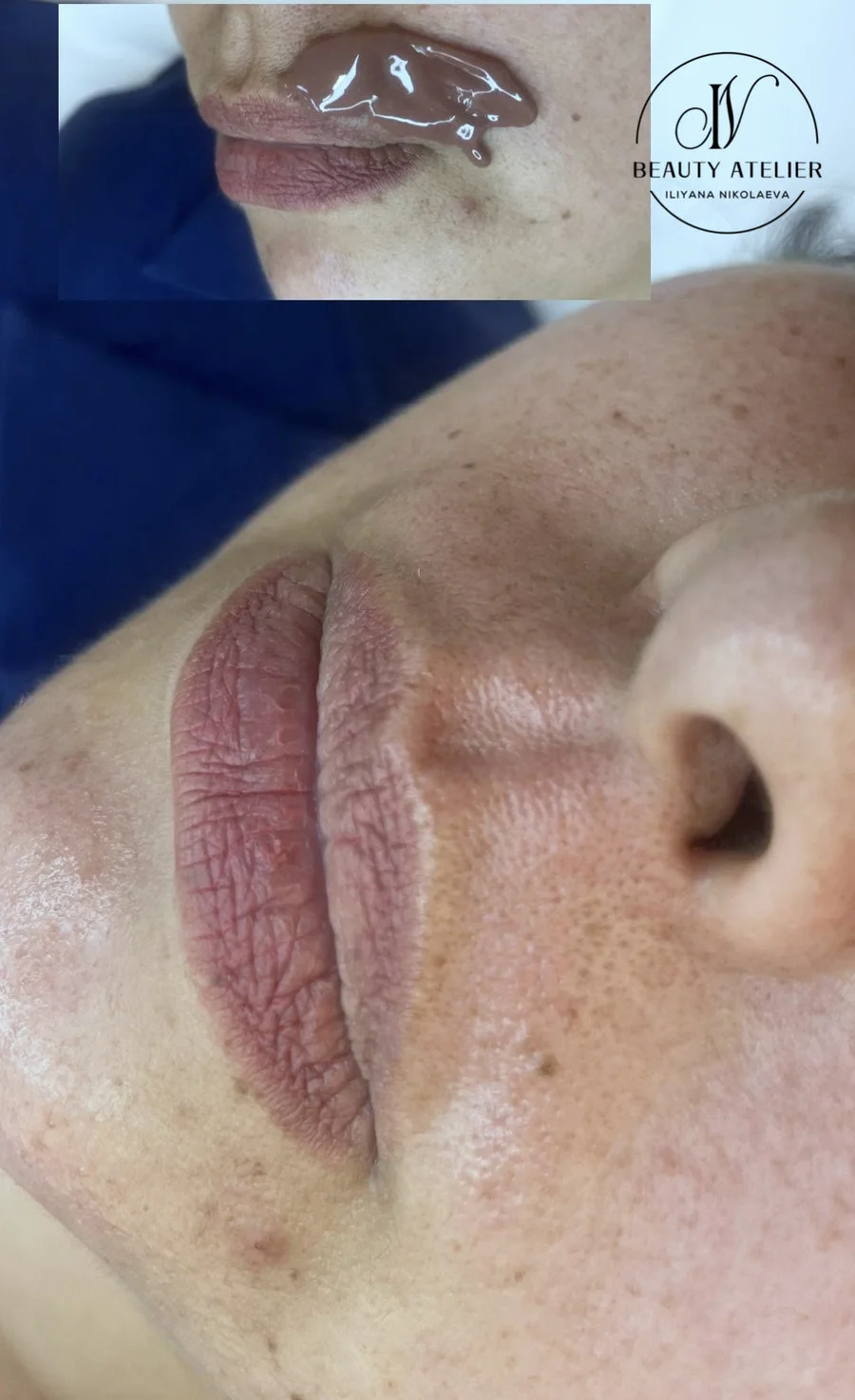 Кола маска с шоколад на горна устна в Beauty Atelier IN, Силистра: нанесена вакса и резултатът веднага след свалянето