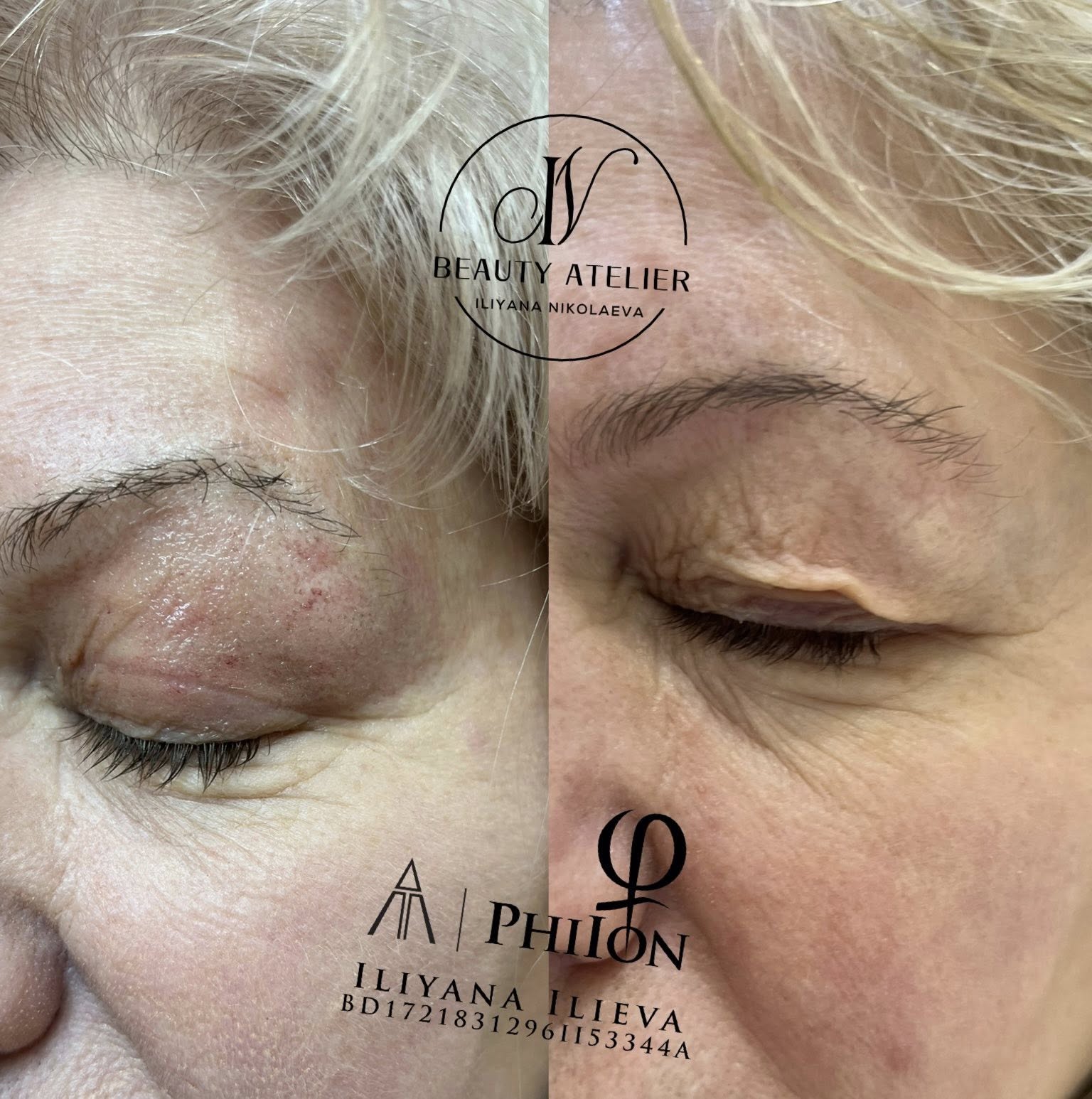 Блефаропластика с плазма пен — лифтинг на клепачите