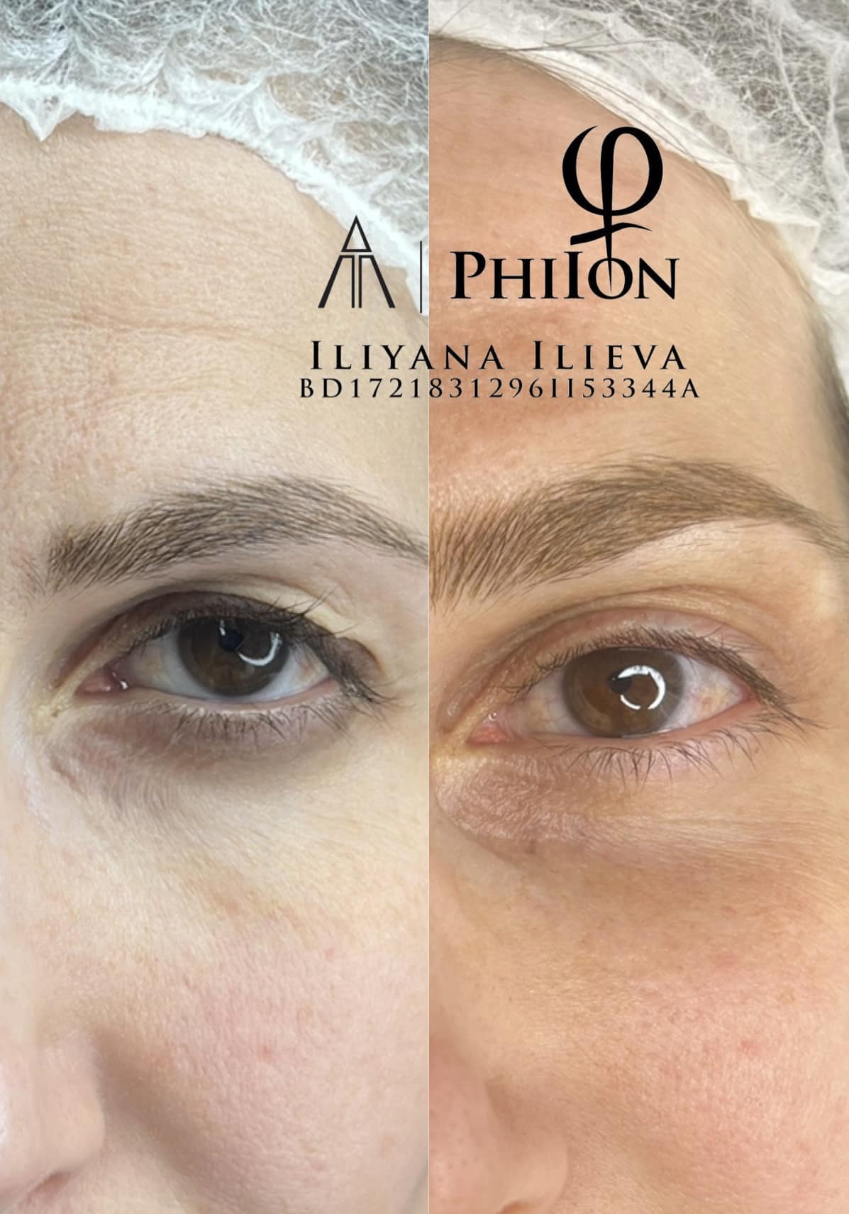 Блефаропластика — без белези, без дълго възстановяване