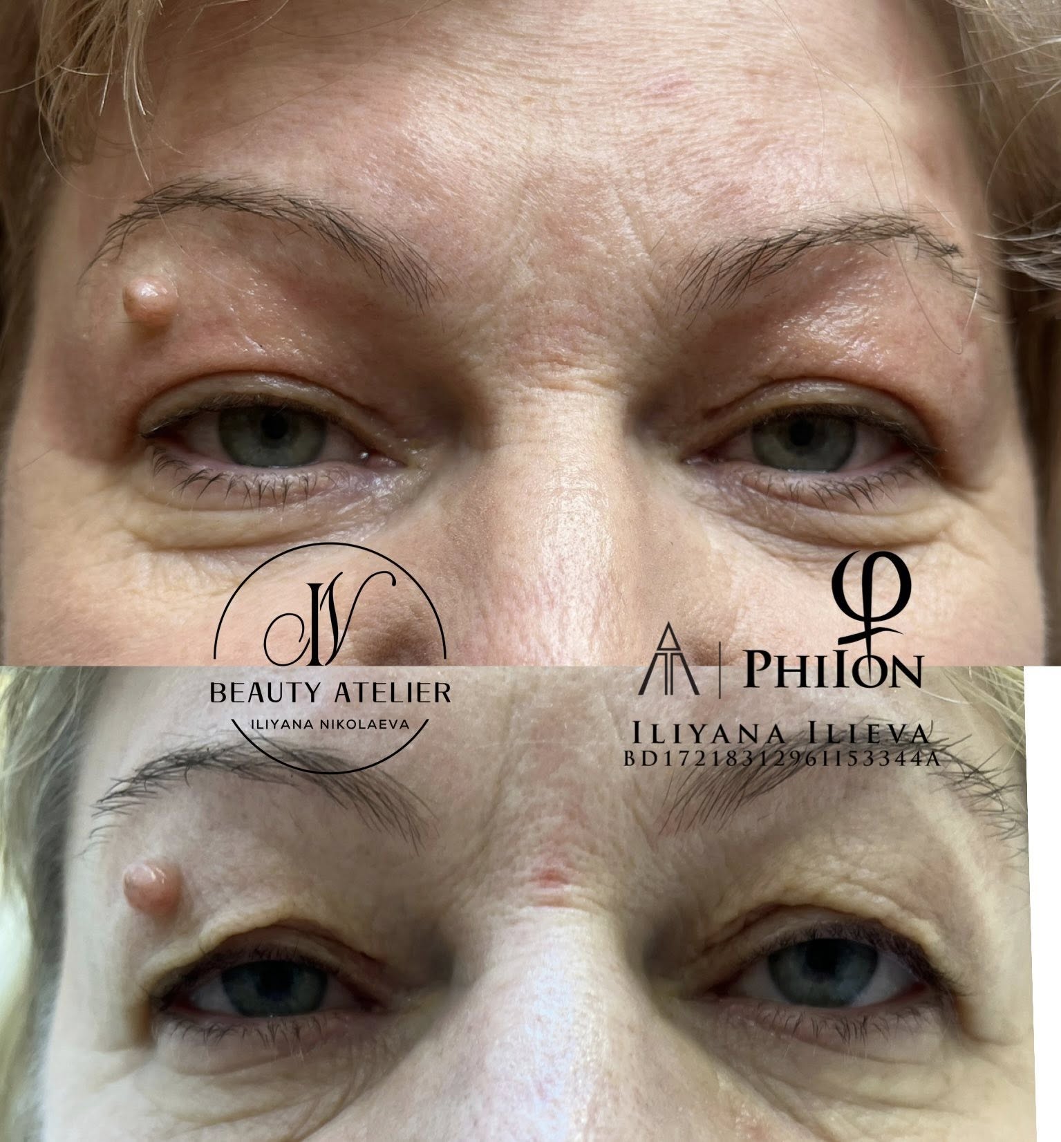 Блефаропластика — стягане на горен клепач без операция