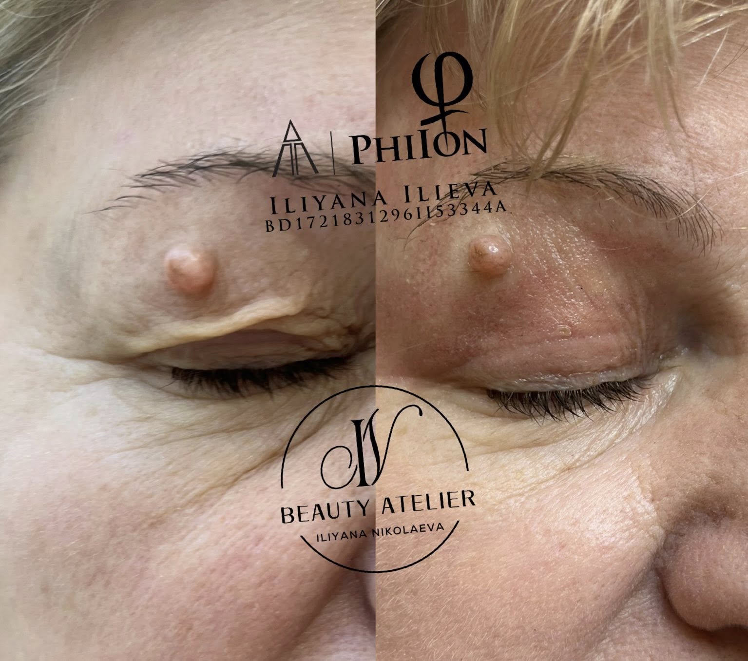 Блефаропластика — видим резултат веднага след процедурата