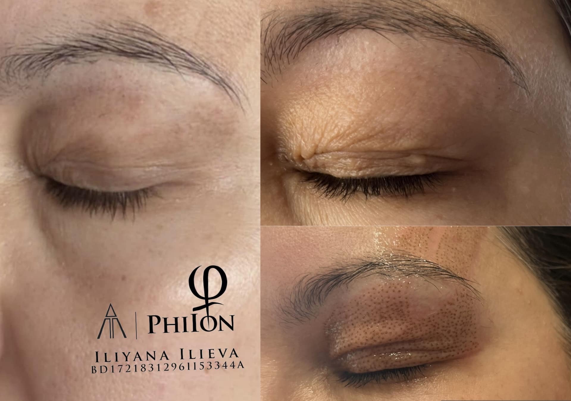 Блефаропластика — по-лек и отворен поглед