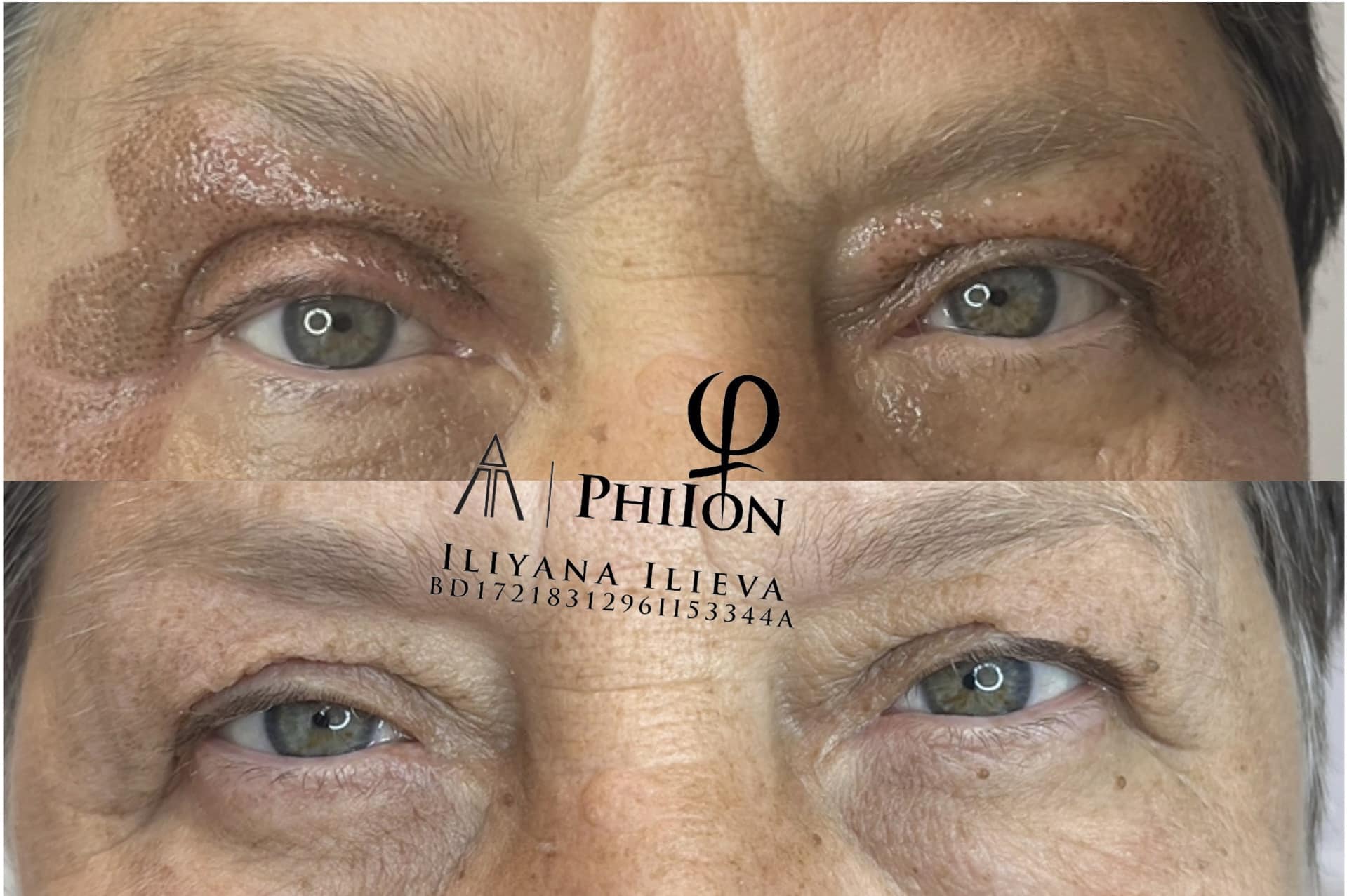Блефаропластика с PhiIon — премахване на излишна кожа