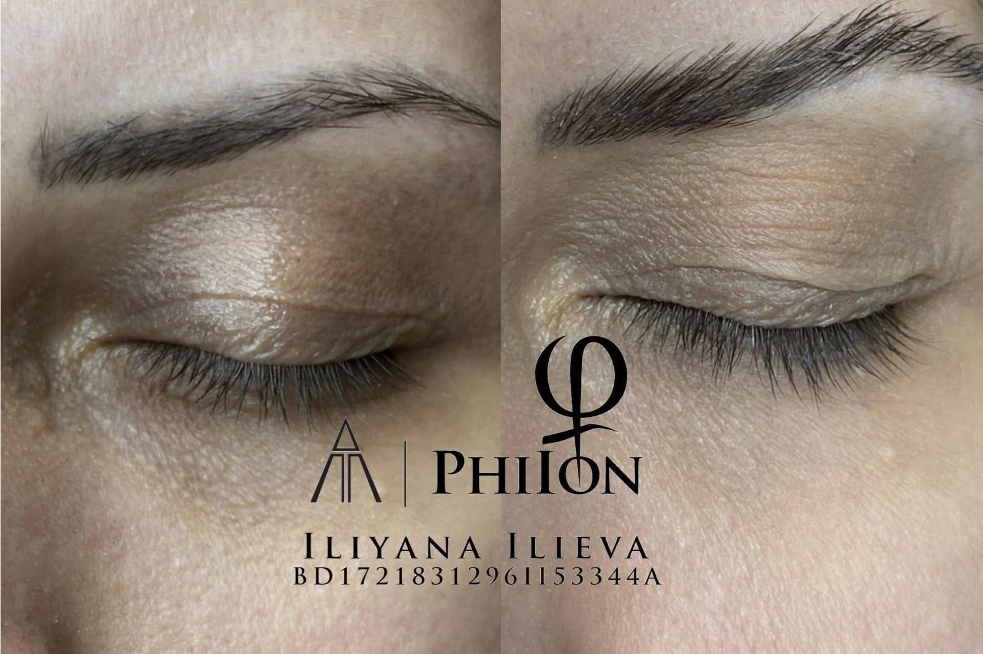 Блефаропластика — естествено подмладяване на погледа