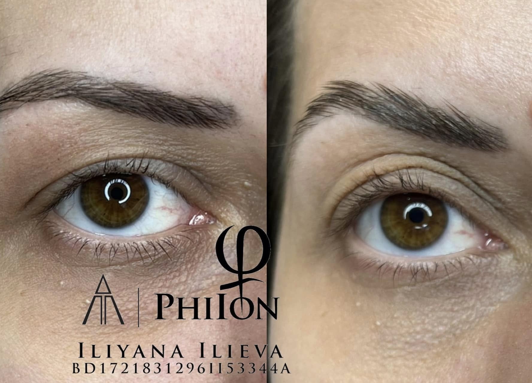 Блефаропластика — резултат от една процедура