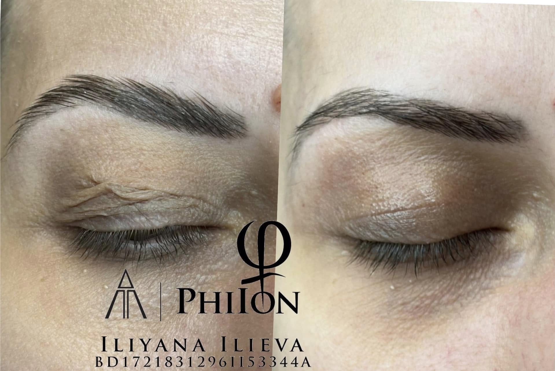 Блефаропластика — нехирургичен лифтинг