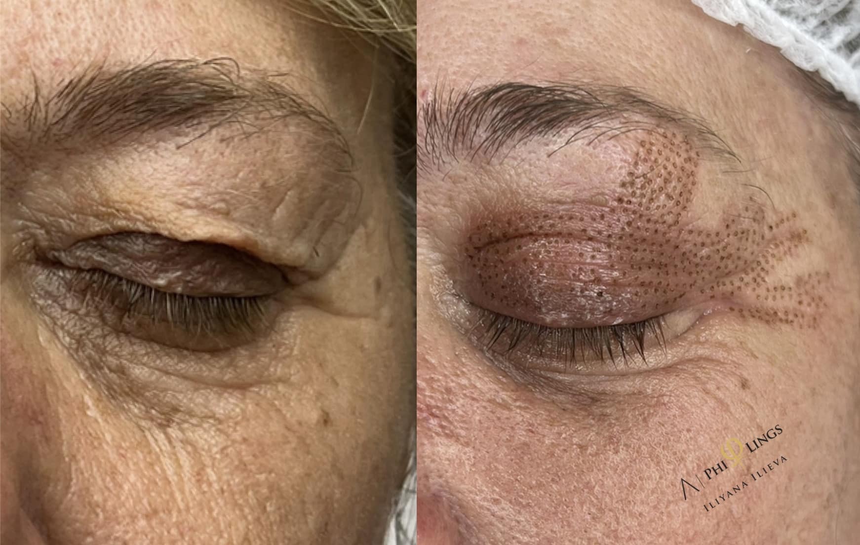 Блефаропластика — стегнат и свеж поглед