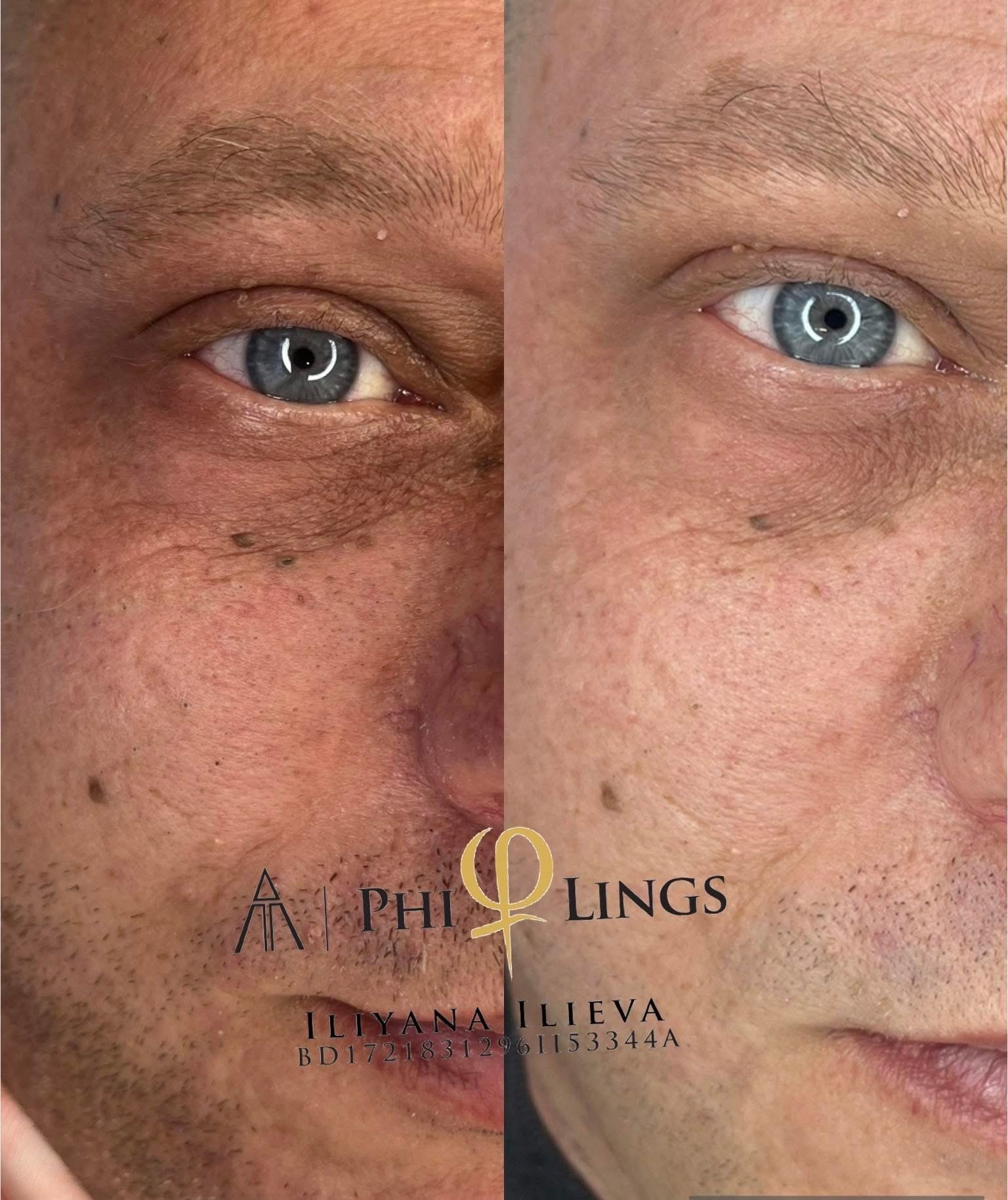 Микронидлинг PhiLings — стимулация на колагена за сияйна кожа