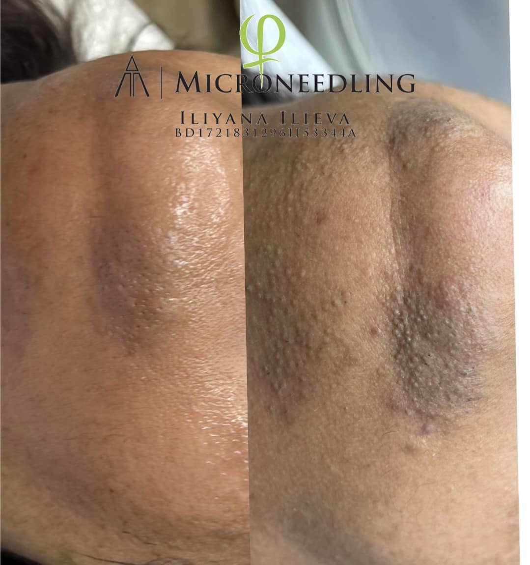 Микронидлинг — изсветляване и възстановяване на кожата