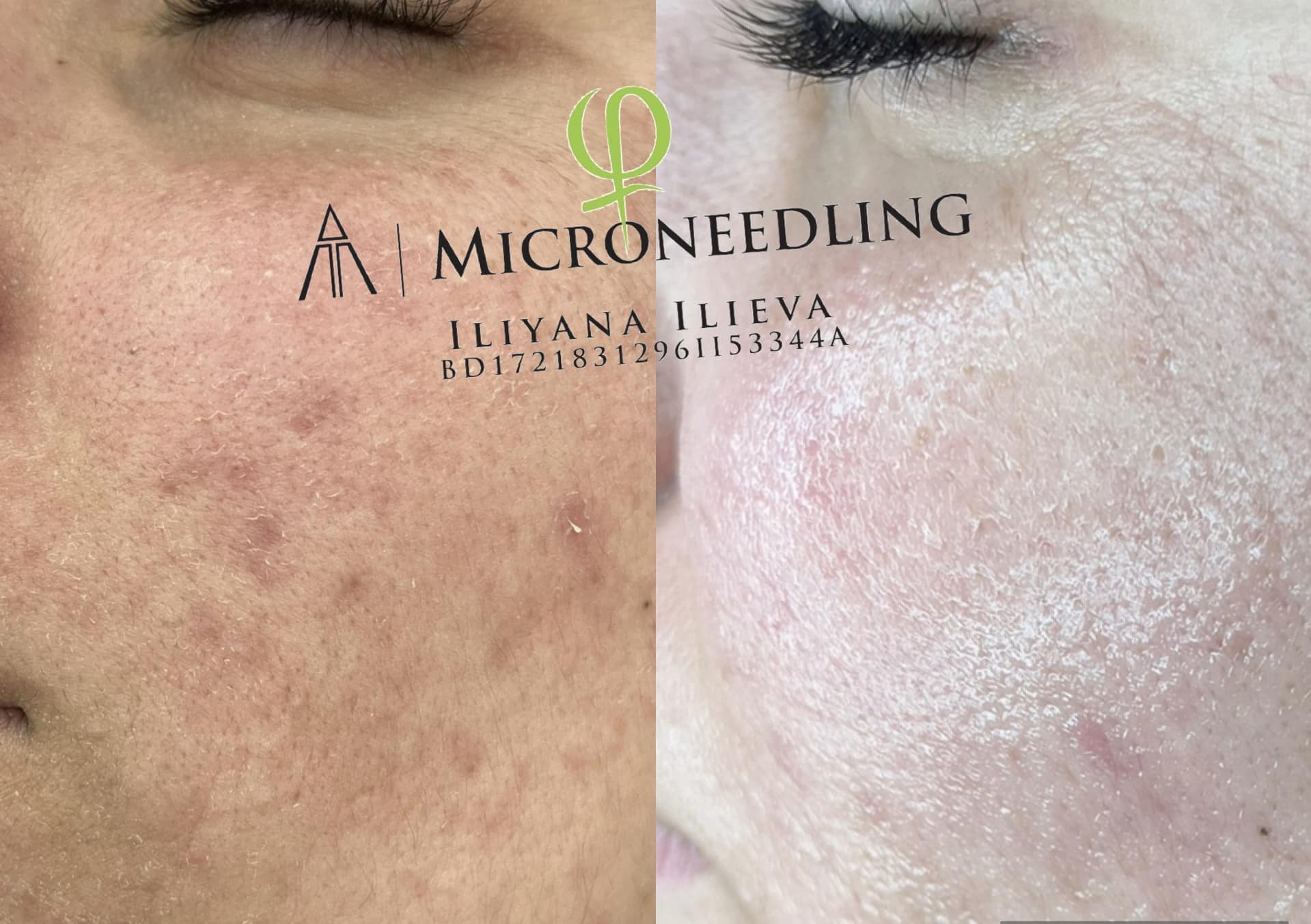 Микронидлинг — намаляване на пигментации и бръчки
