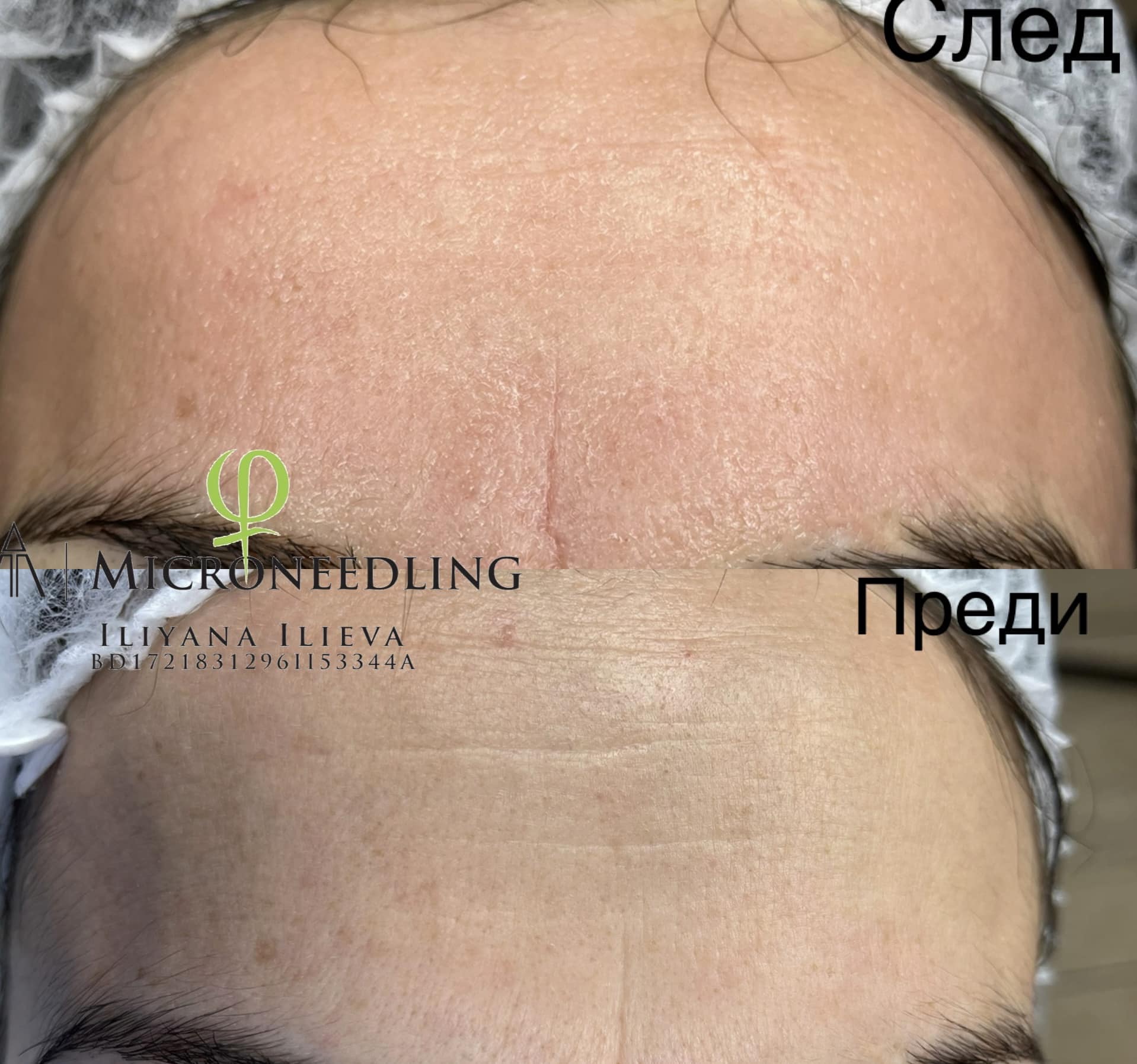 Микронидлинг — изглаждане на фини линии на челото