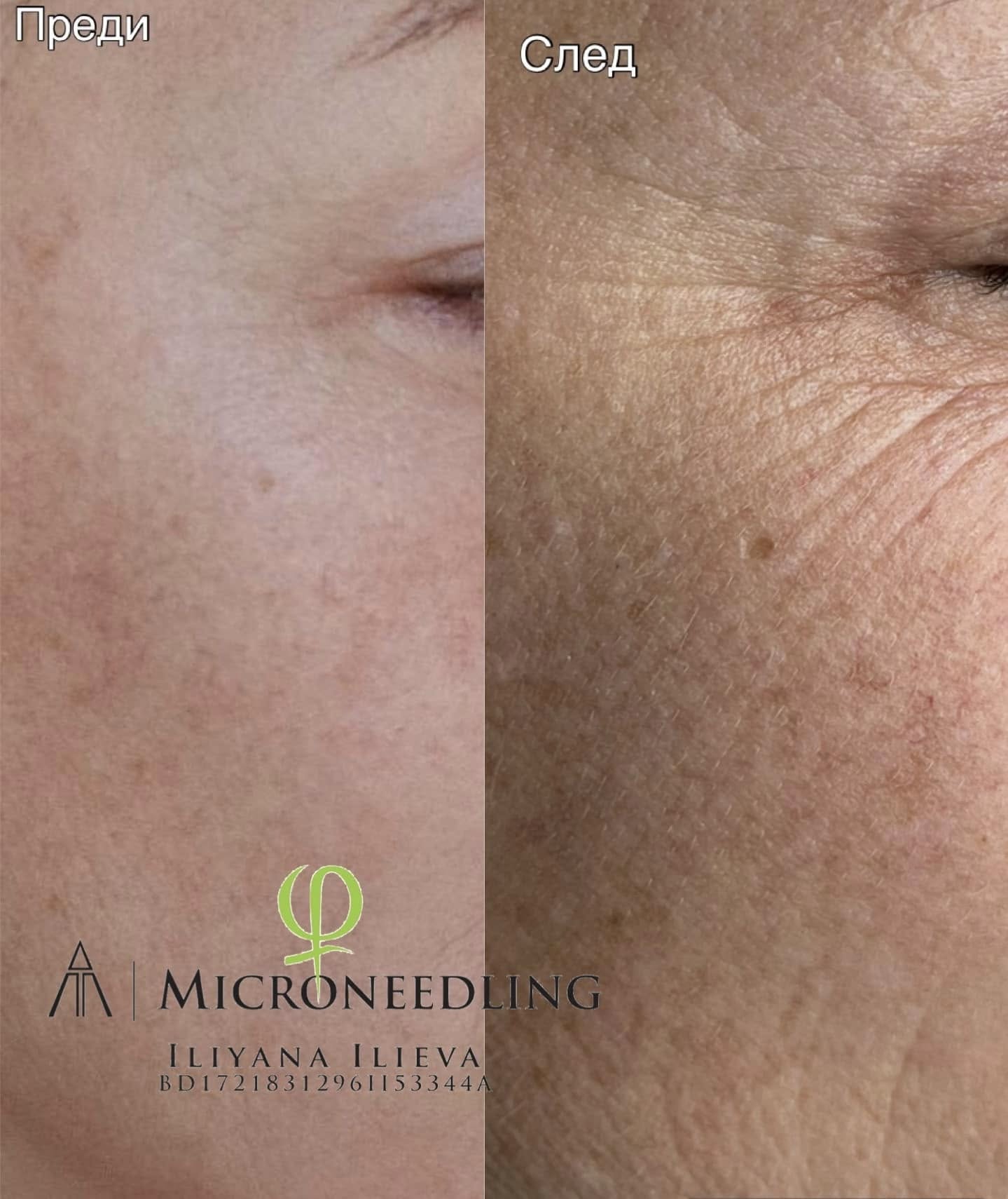 Микронидлинг — свежа и младежка визия