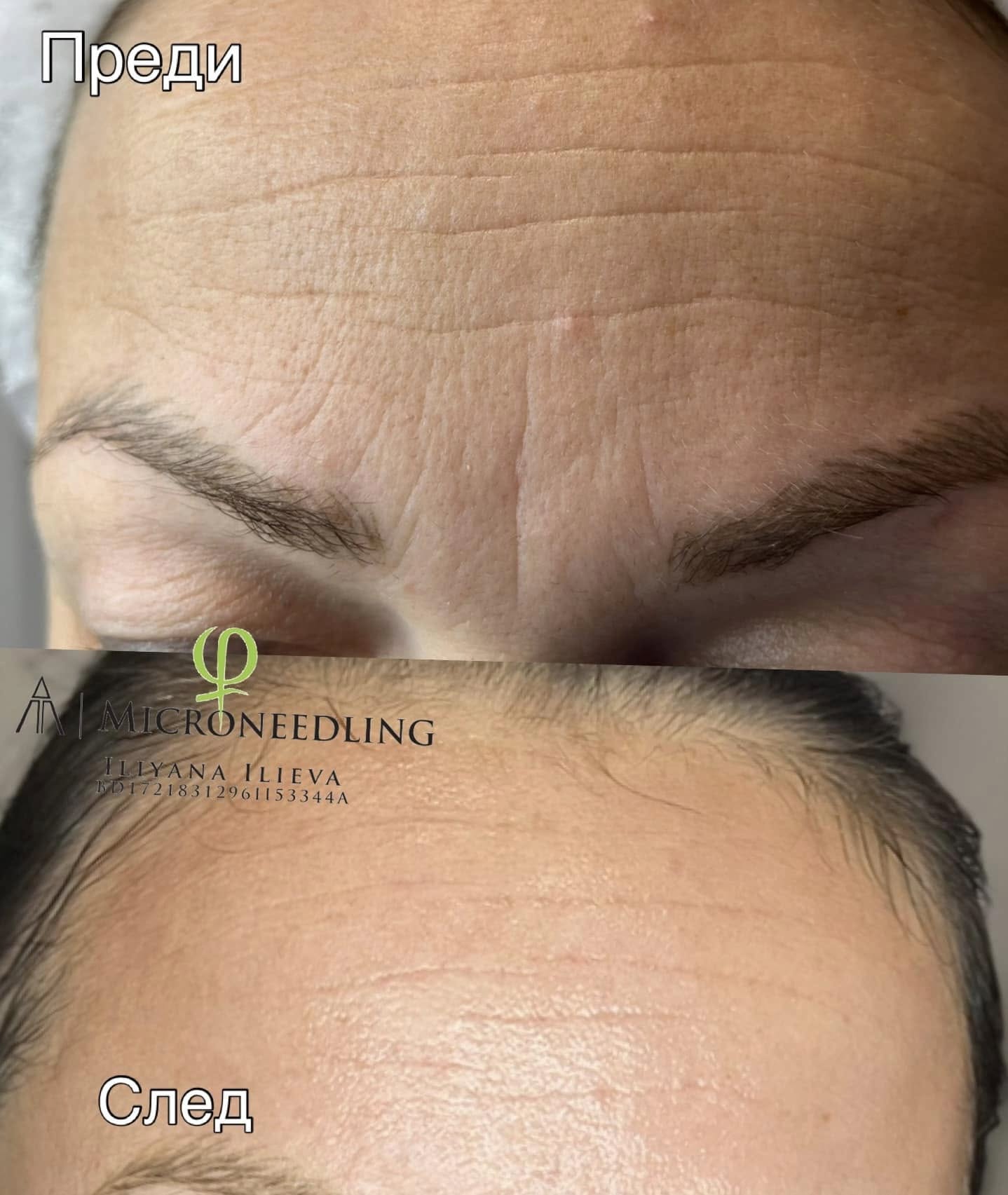 Микронидлинг — подобряване текстурата на кожата