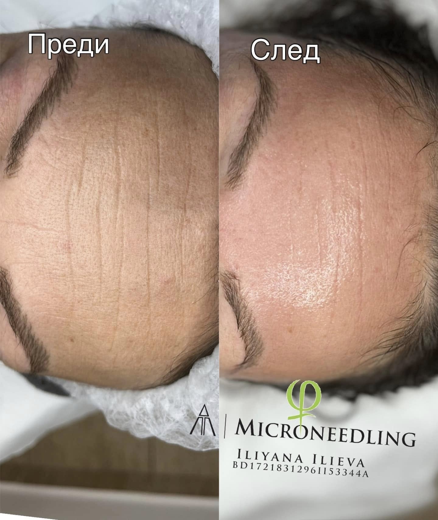 Микронидлинг — преди и след при мимически бръчки