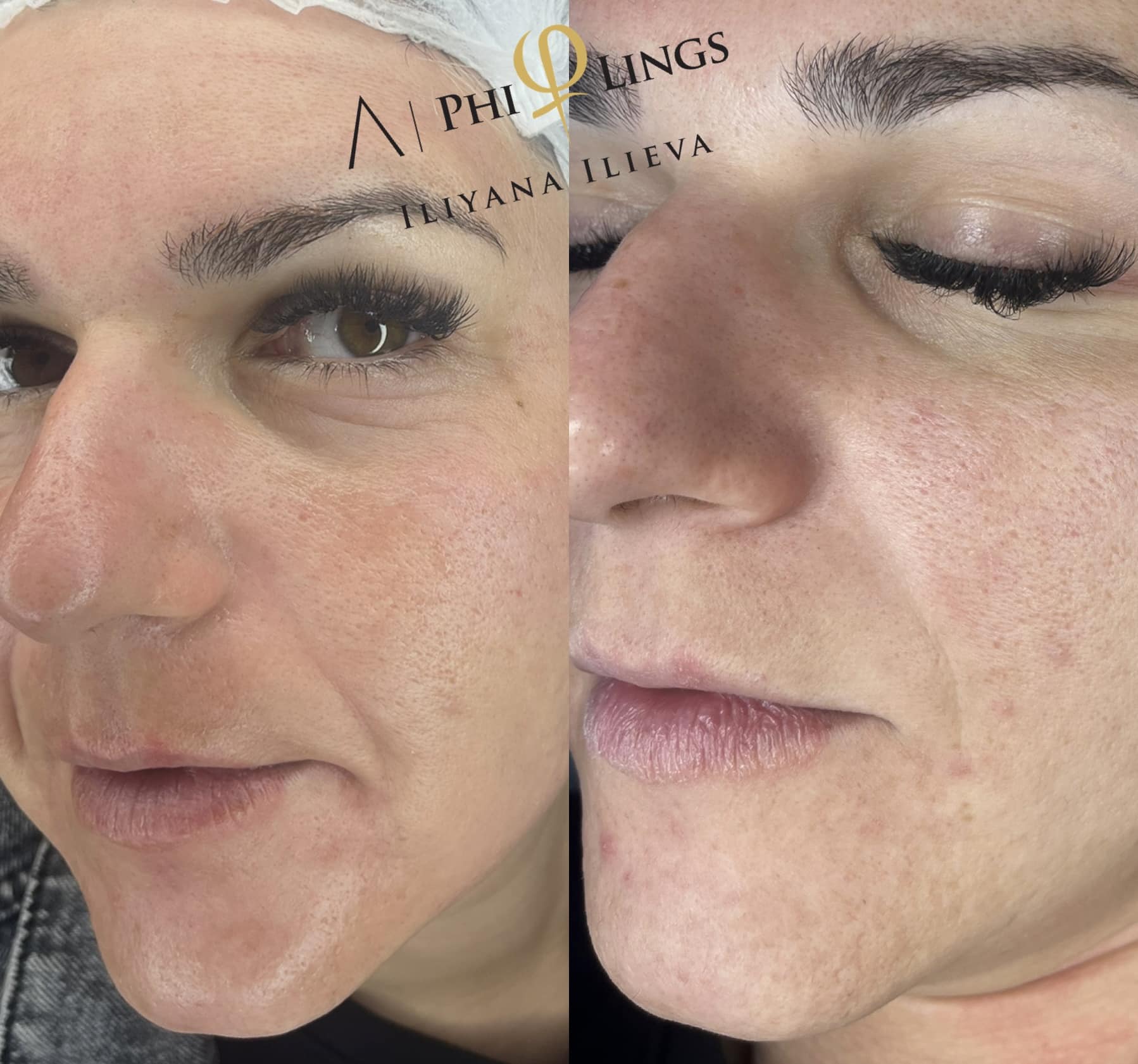 Микронидлинг — хидратация и заглаждане на кожата