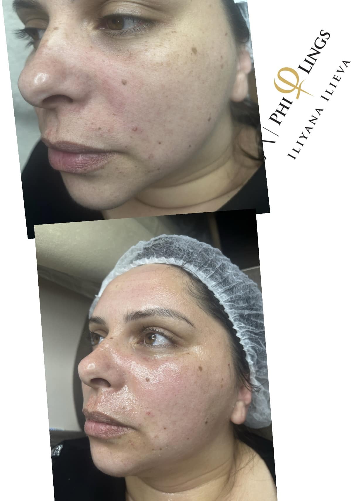 Микронидлинг PhiLings — стягане и подмладяване