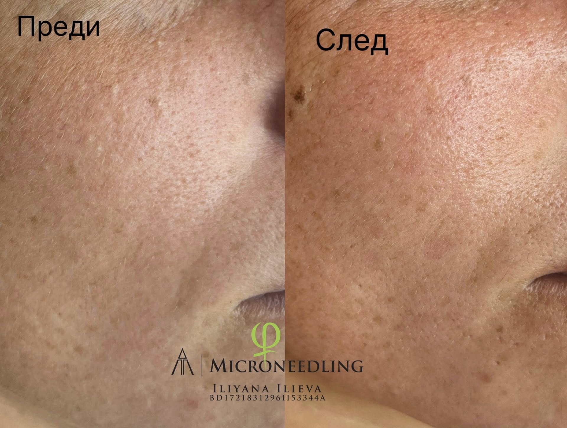 Микронидлинг — борба с фини линии и разширени пори