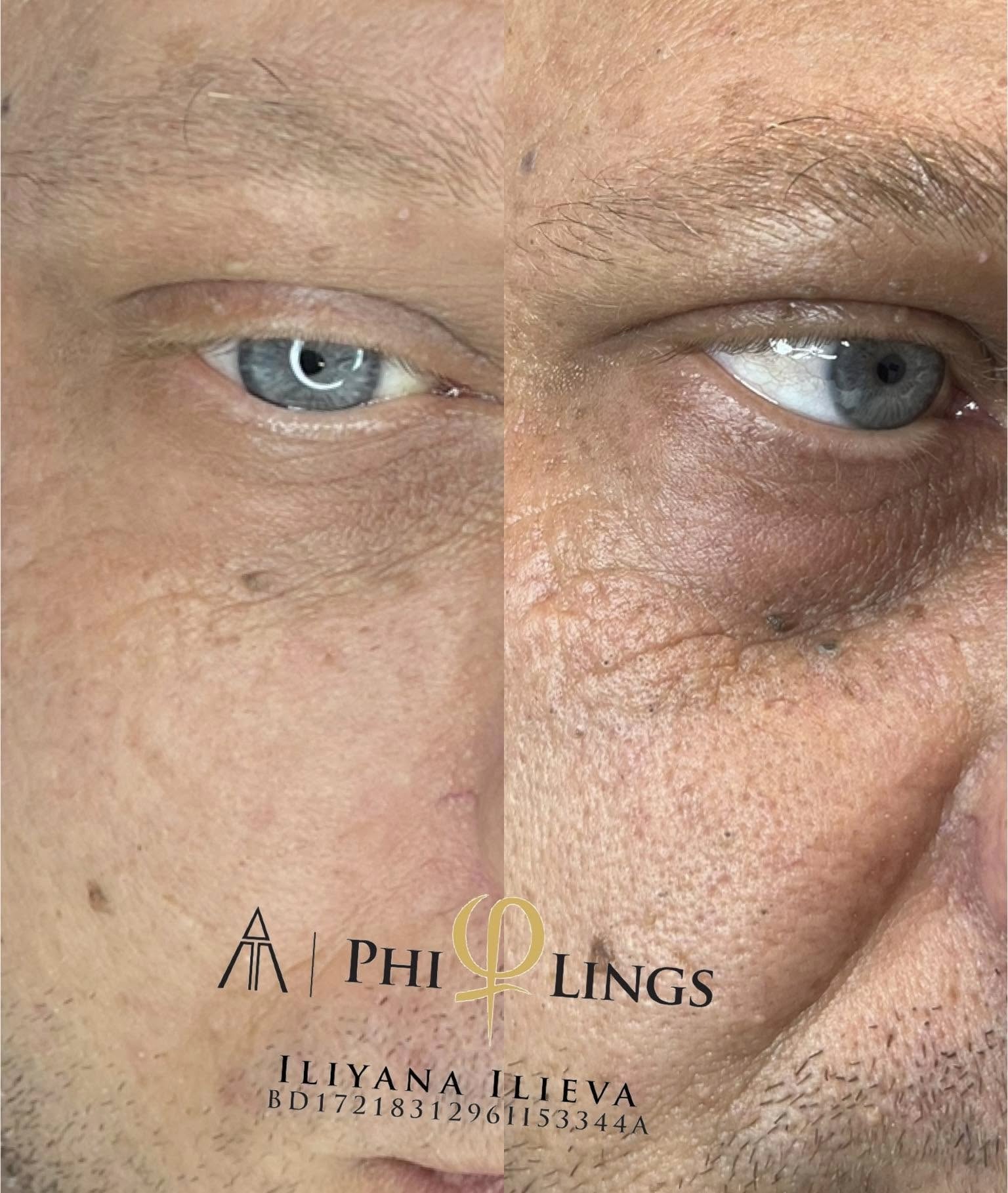 Микронидлинг — подмладяване и регенерация на кожата