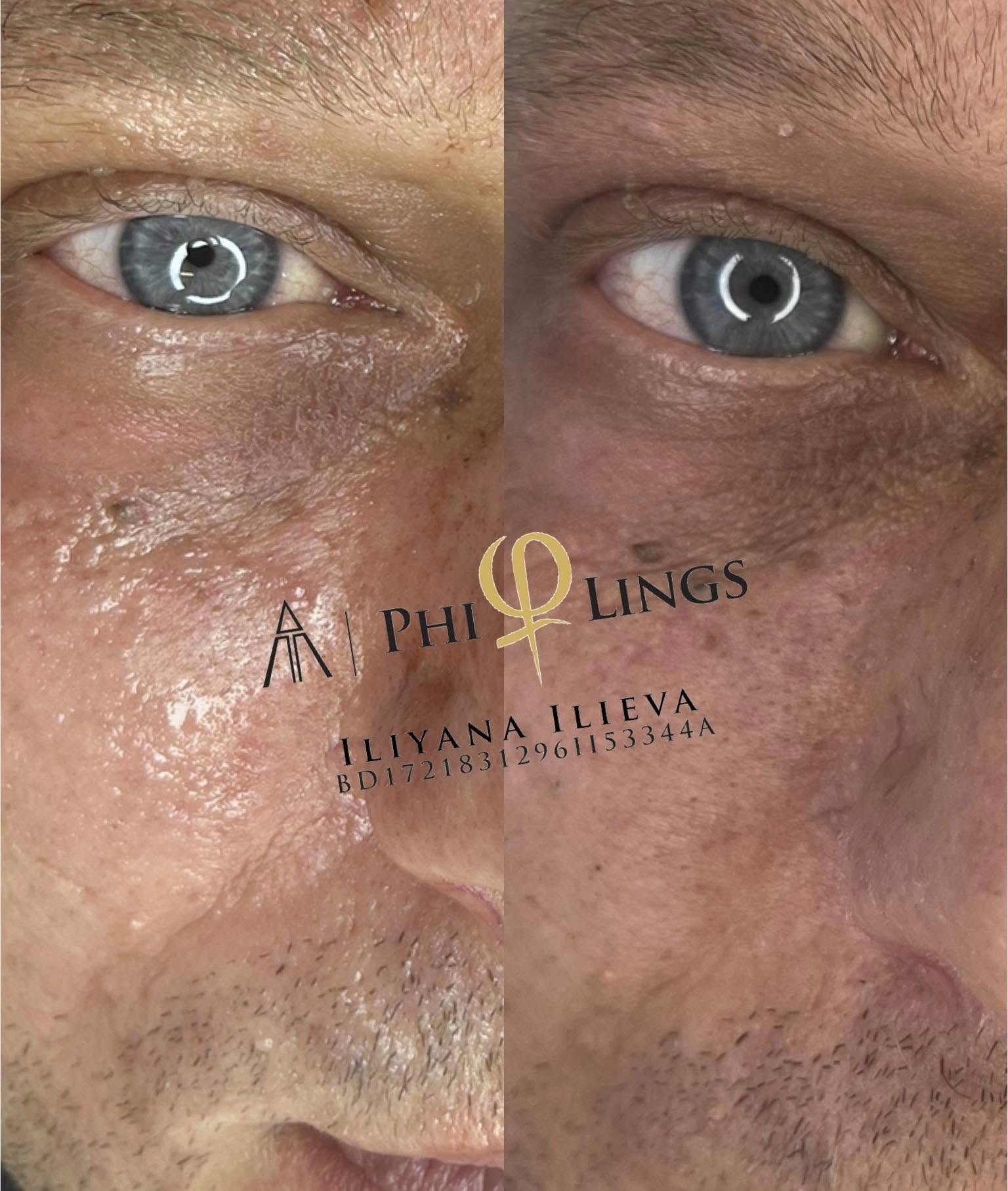 Микронидлинг — изглаждане на белези от акне