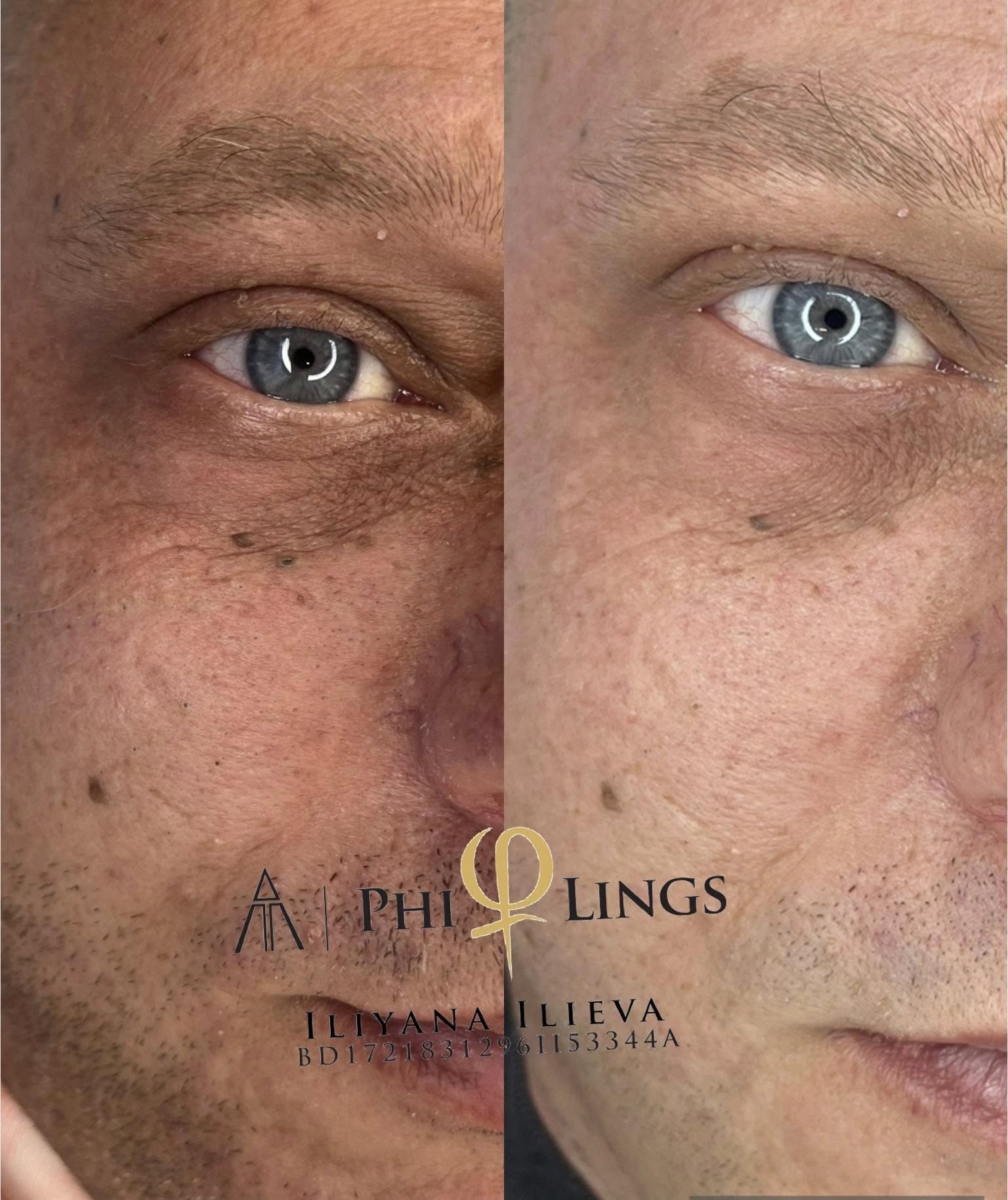 Микронидлинг PhiLings — видим резултат преди и след