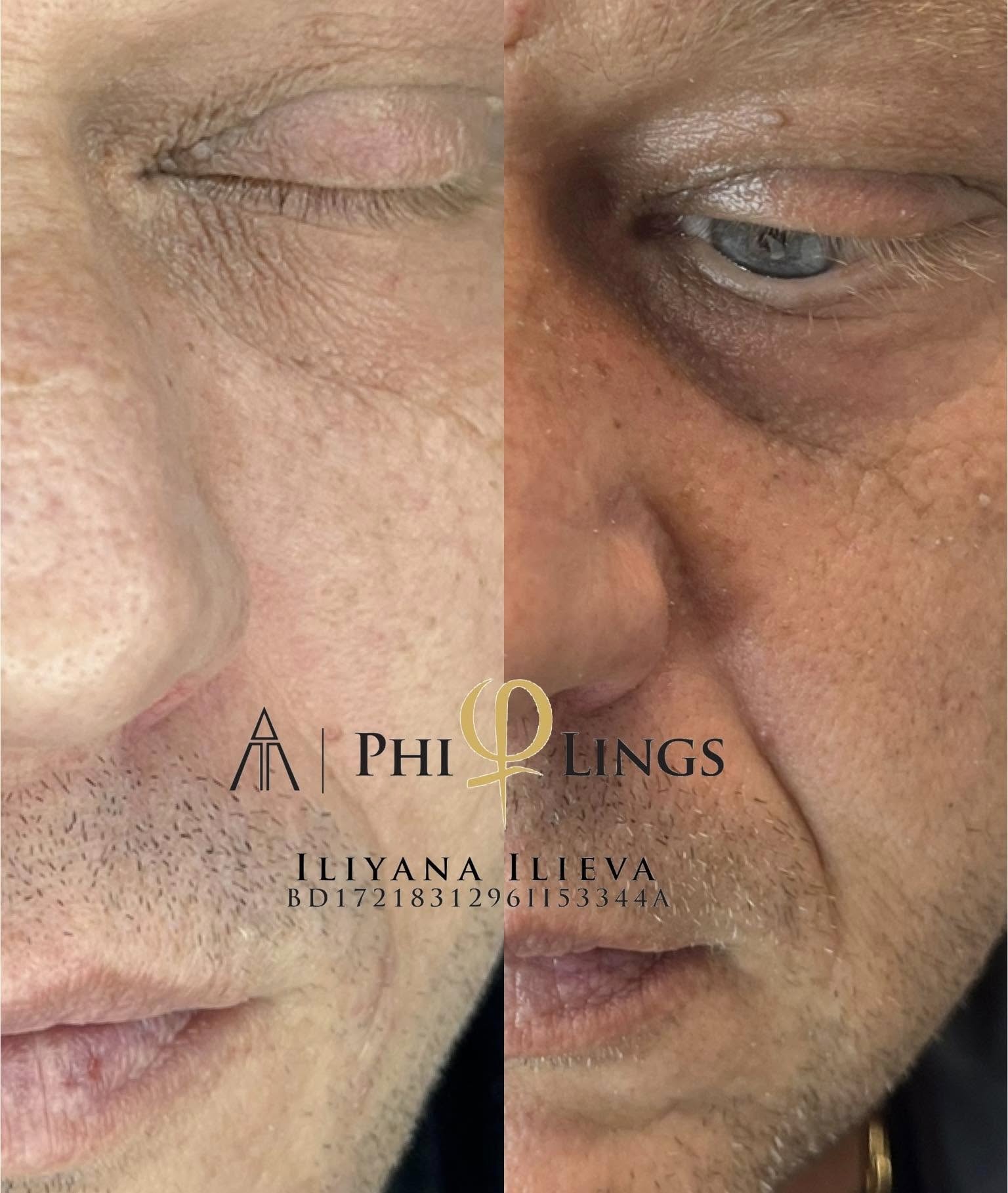 Микронидлинг — озарена и подхранена кожа веднага след процедурата