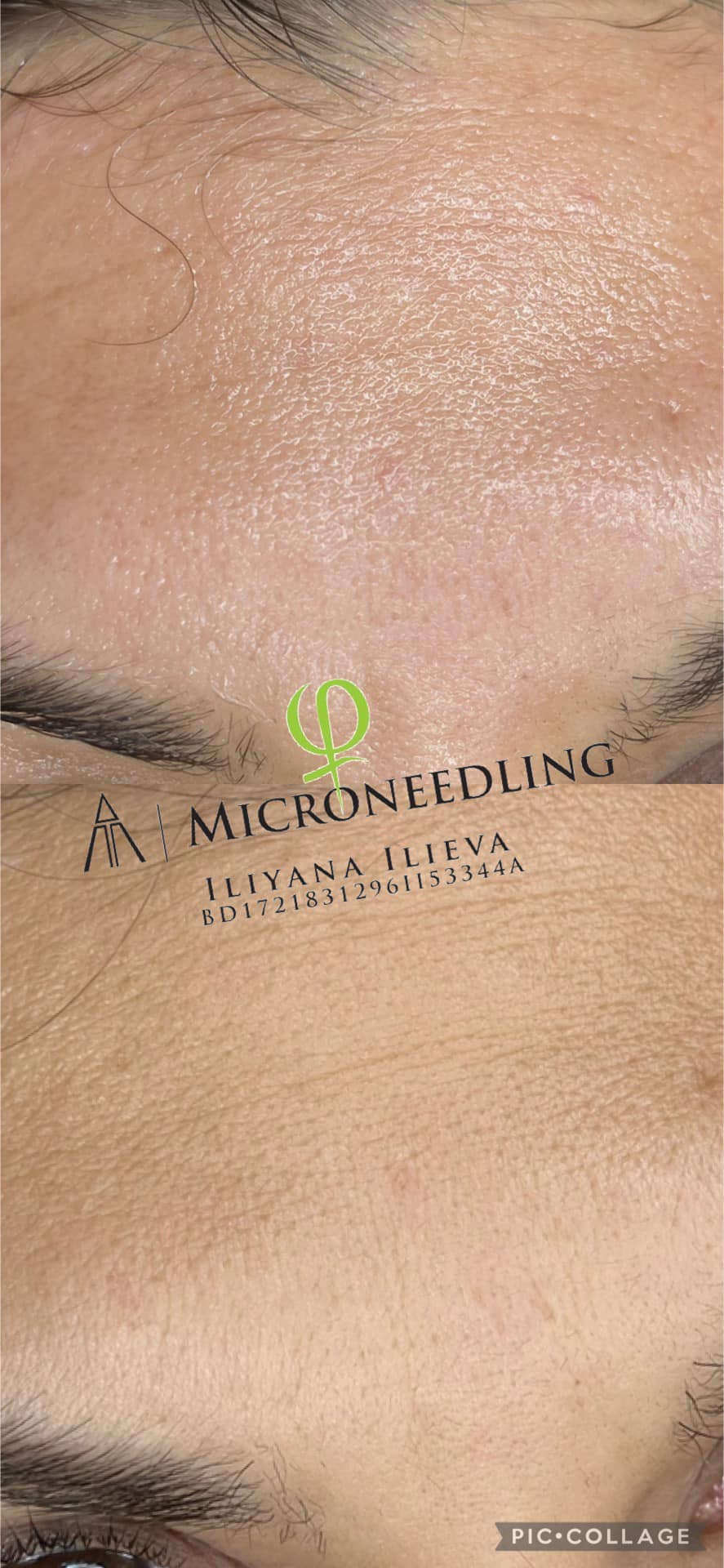 Микронидлинг — дискретна промяна, реален резултат