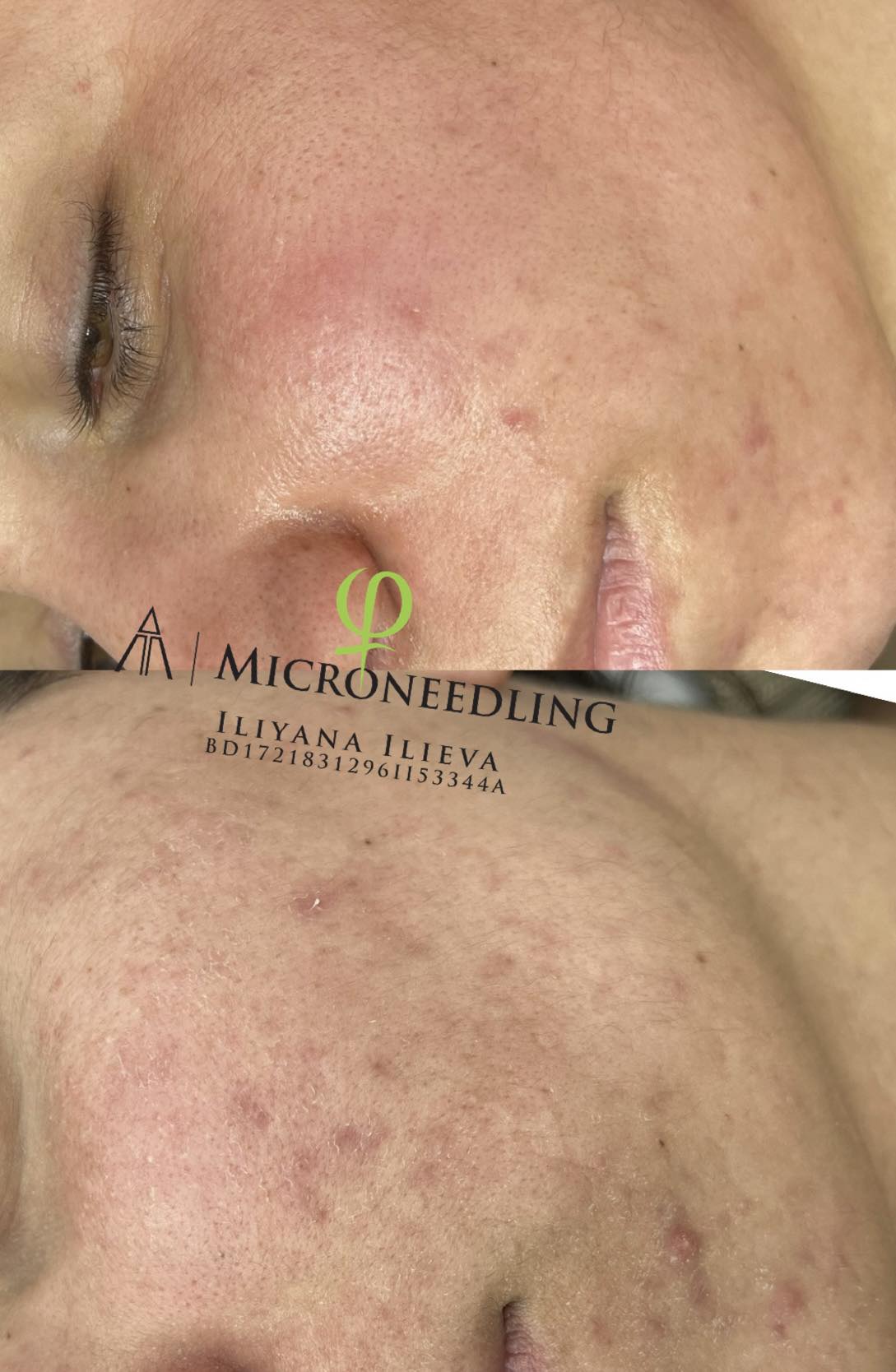 Микронидлинг — борба с белези от акне и дехидратация