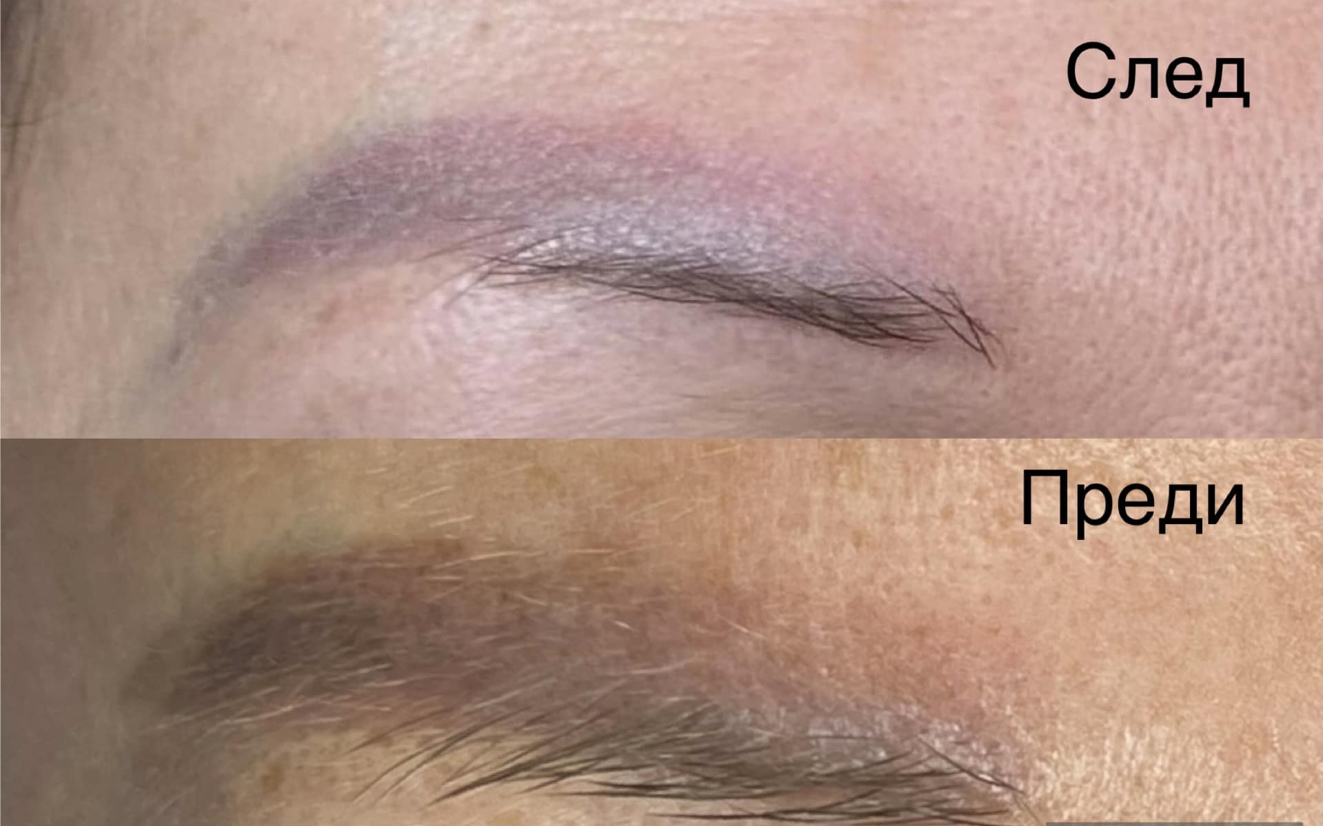 Премахване на стар микроблейдинг с PhiRemoval — обновяване на кожата