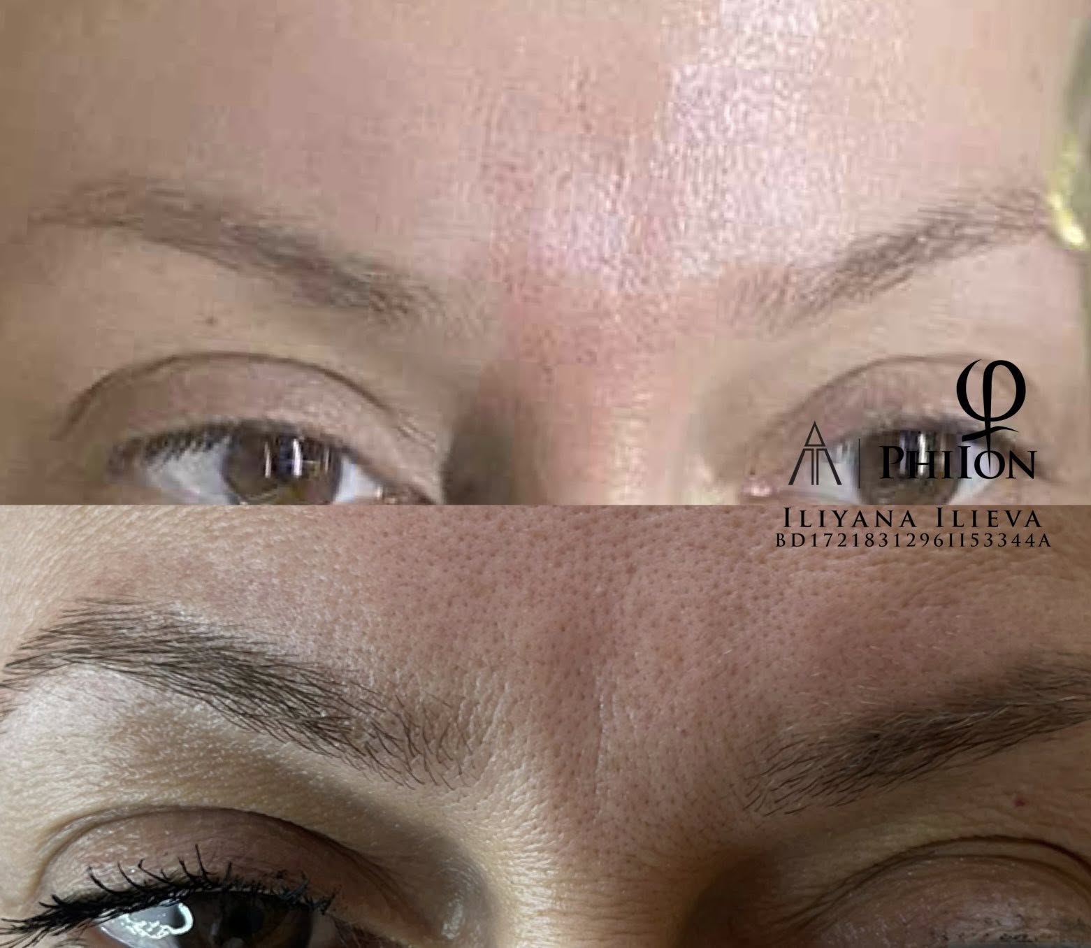 Плазма пен PhiIon — гневна бръчка