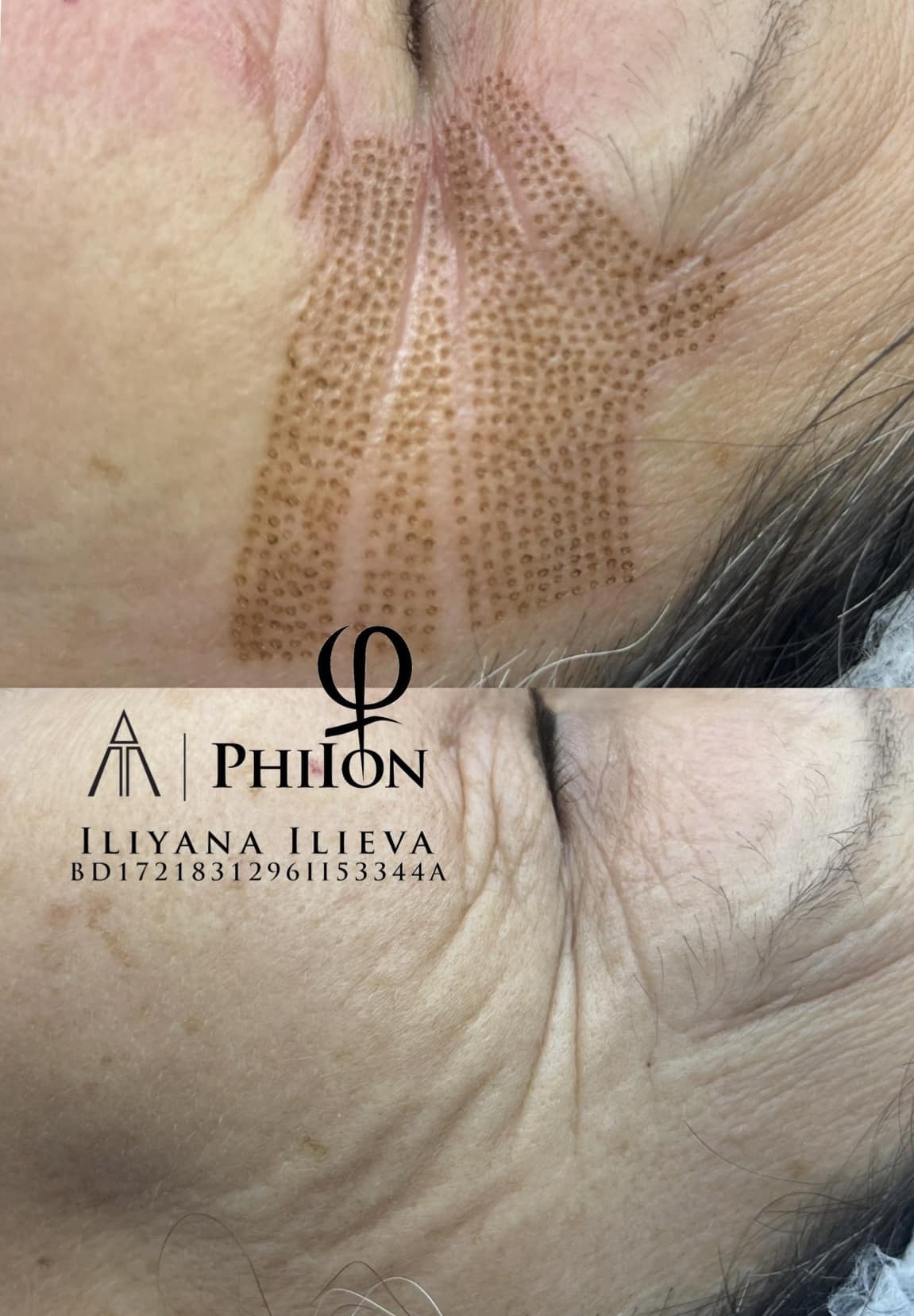 Плазма пен — пачи крак