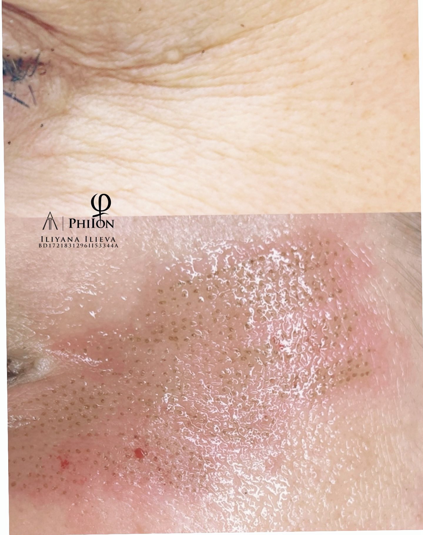 Плазма пен — подмладяване без хирургична намеса