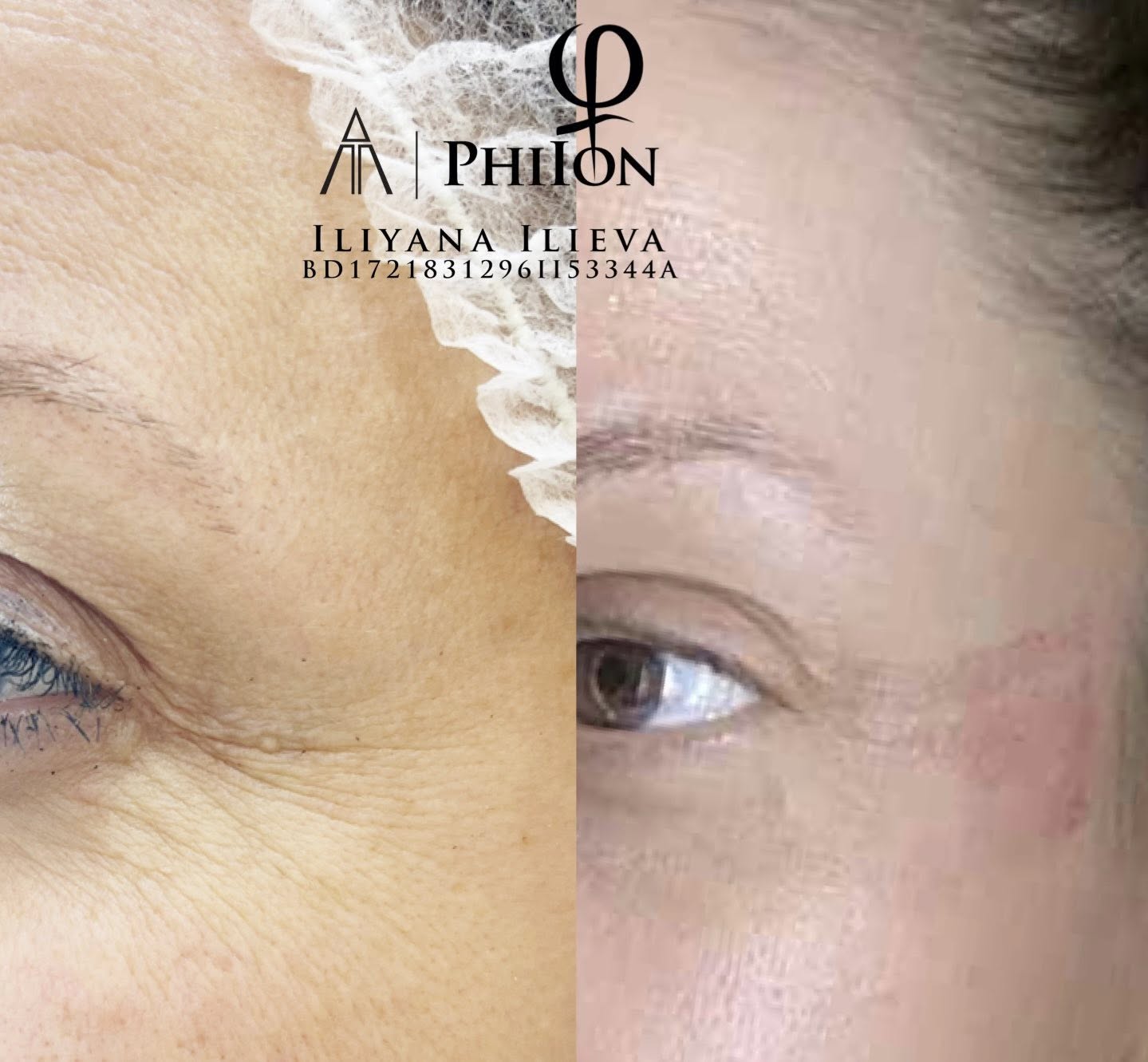 Плазма пен — стягане на кожата с видим резултат