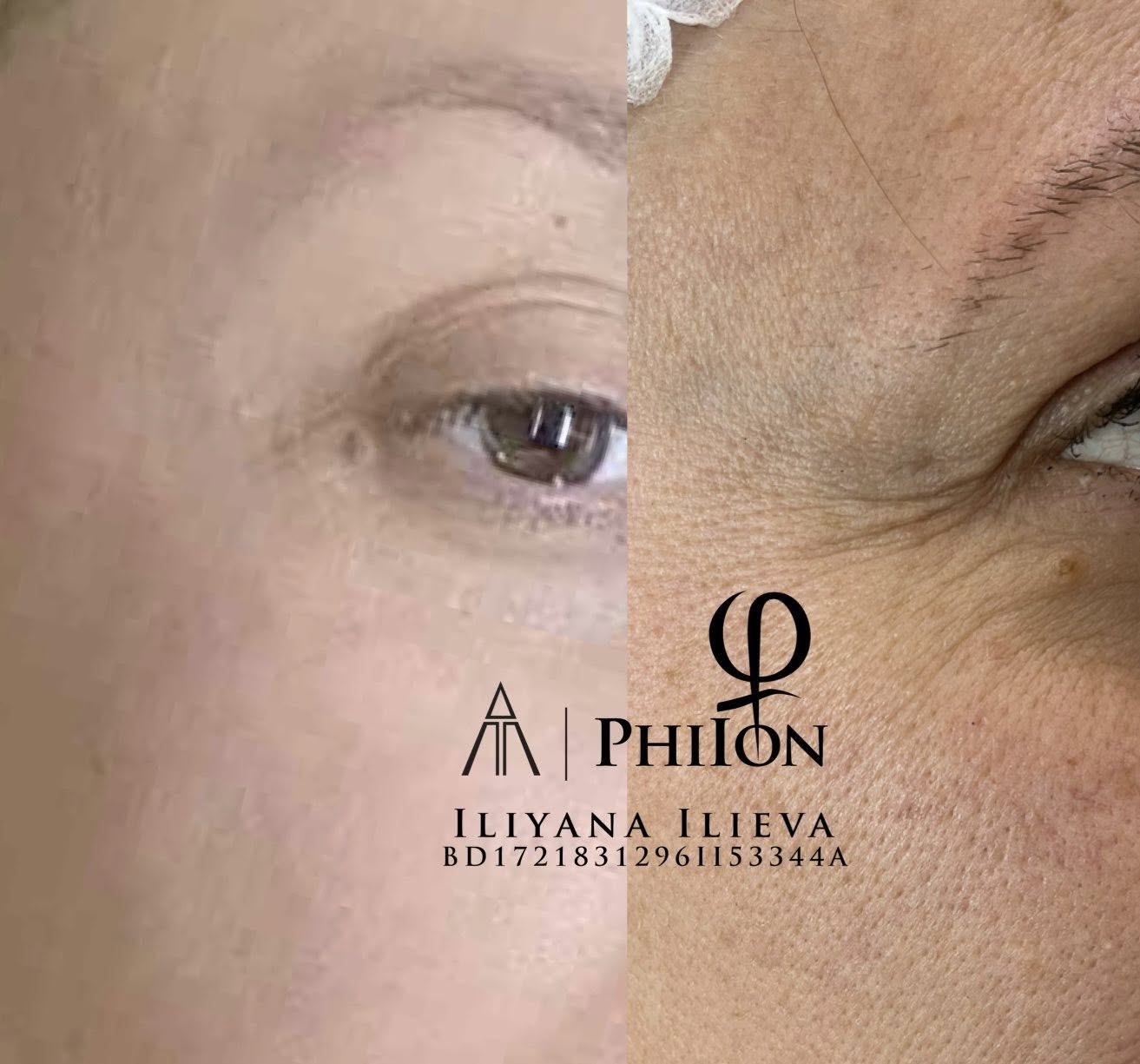 Плазма пен — изглаждане на фини линии около очите