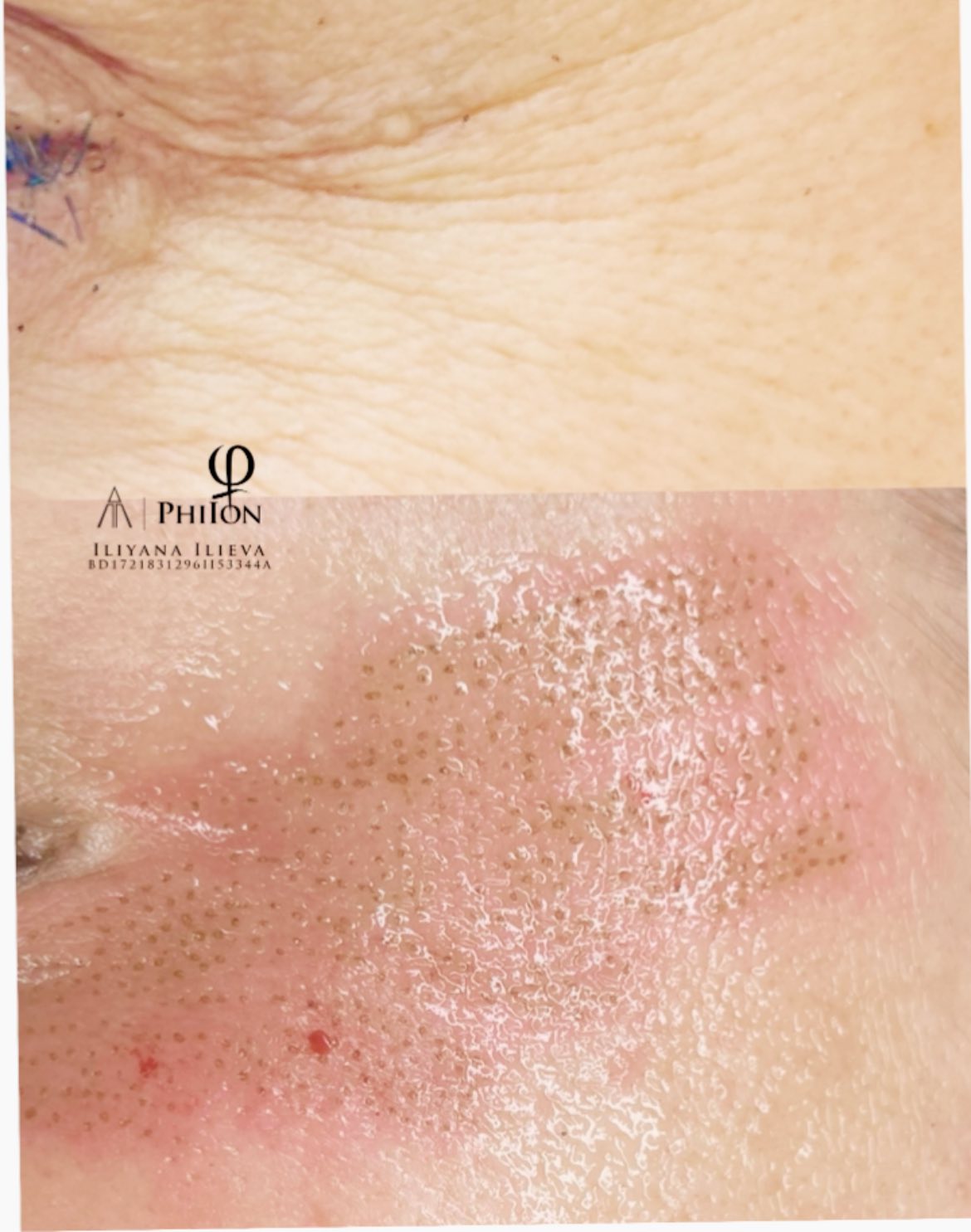 Плазма пен PhiIon — контролирана регенерация на кожата