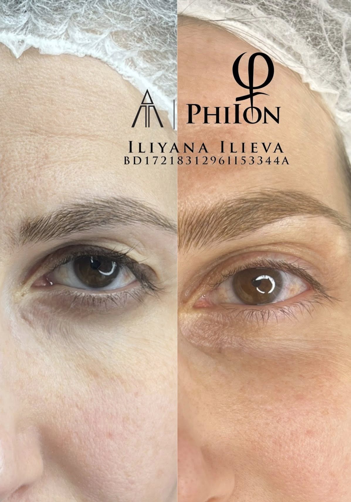 Плазма пен — намаляване на бръчки и отпусната кожа