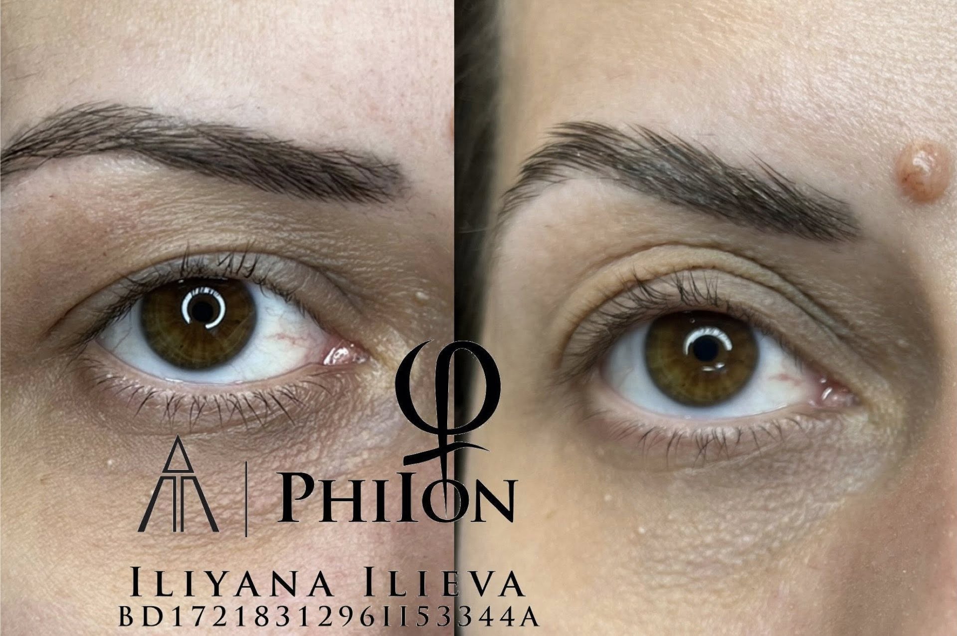 Плазма пен PhiIon — премахване на кожни несъвършенства