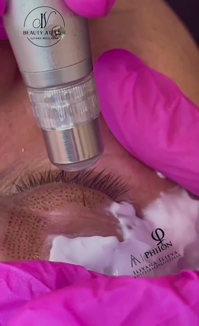 Плазма пен PhiIon — процедура в действие