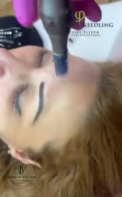 Микронидлинг — процедура за подмладяване