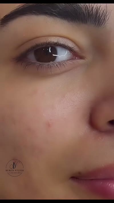 Микронидлинг — сияйна и обновена кожа