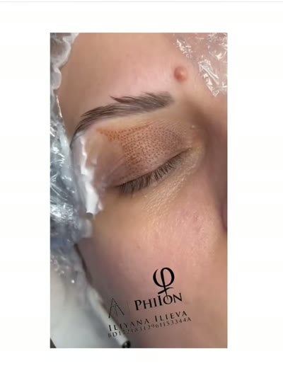 Плазма пен PhiIon — третиране на клепачи